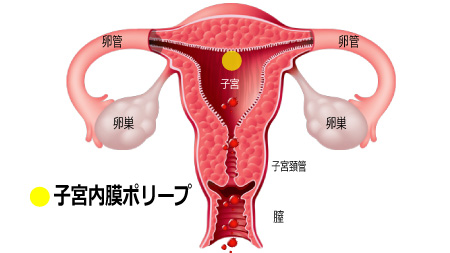 子宮内膜ポリープの悪性の可能性、悪性だった場合の治療法